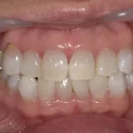 ホワイトニング　症例
