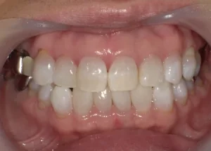 ホワイトニング　症例