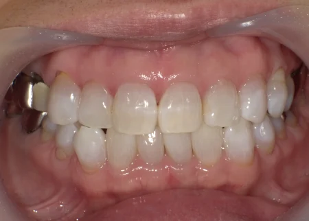 ホワイトニング　症例