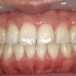 ホワイトニング　症例