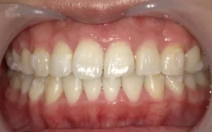 ホワイトニング　症例
