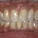 ホワイトニング　症例