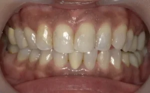 ホワイトニング　症例