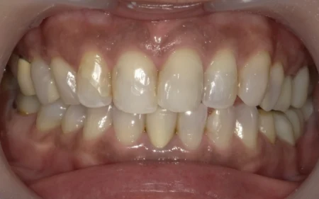 ホワイトニング　症例