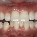 ホワイトニング　症例
