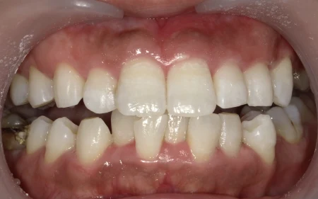 ホワイトニング 症例