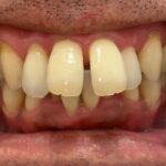インビザライン治療　症例