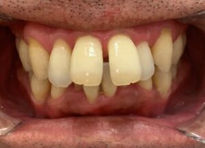 インビザライン治療　症例