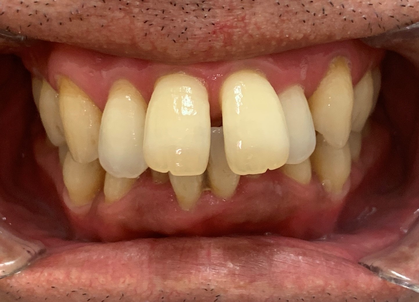 インビザライン治療 症例