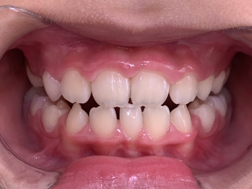 小児矯正　症例