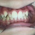 小児矯正　症例