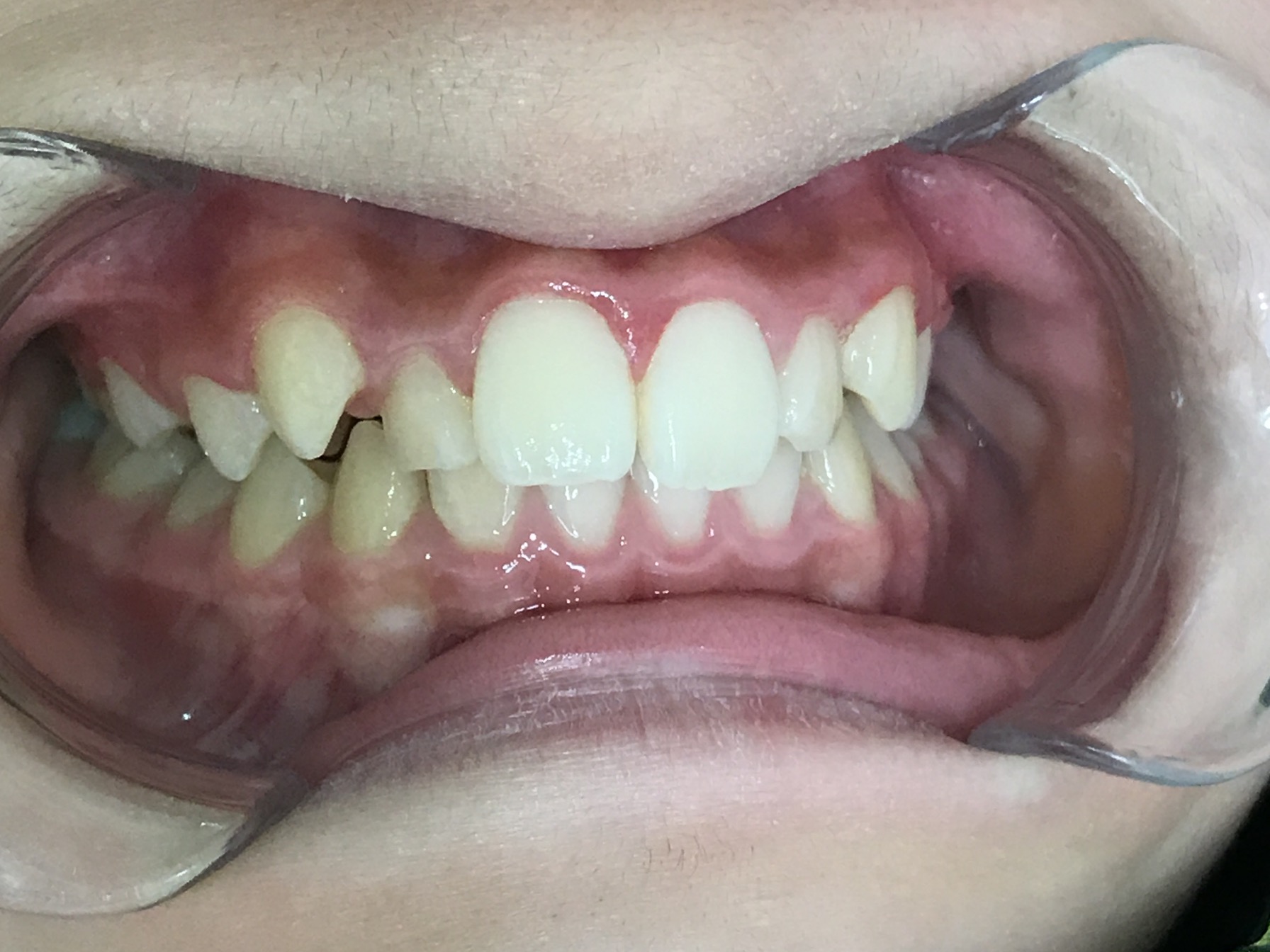 小児矯正　症例