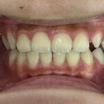 小児矯正　症例