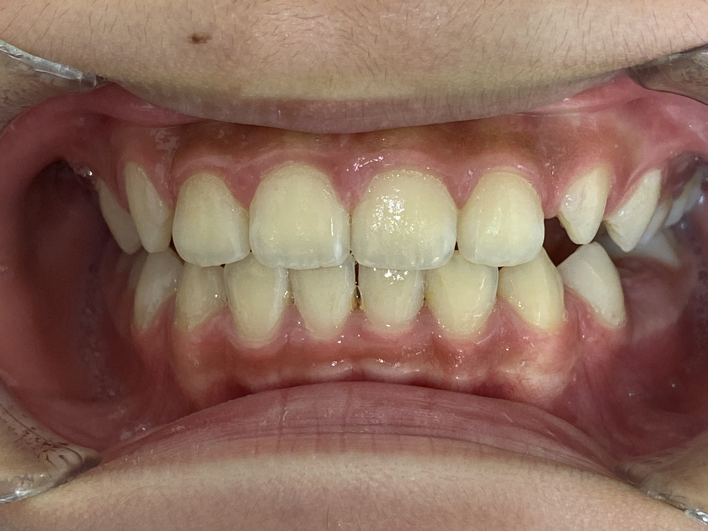 小児矯正　症例