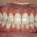 ホワイトニング　症例