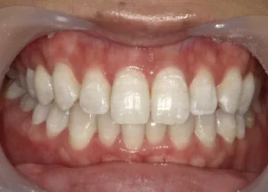 ホワイトニング　症例