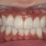 ホワイトニング　症例
