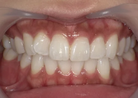 ホワイトニング　症例