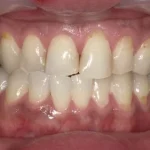 ホワイトニング　症例