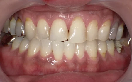 ホワイトニング　症例