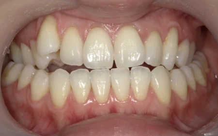 ホワイトニング　症例