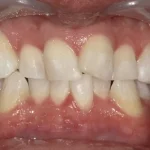 ホワイトニング　症例