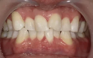 ホワイトニング　症例