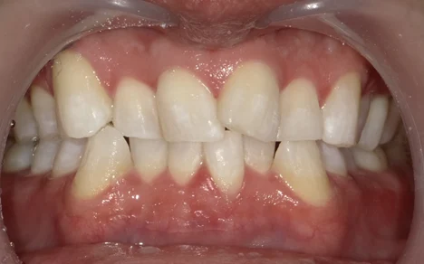 ホワイトニング 症例