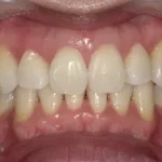 ホワイトニング　症例