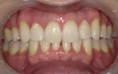 ホワイトニング　症例