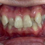 インビザライン治療　症例