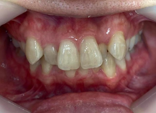 インビザライン治療 症例