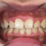 インビザラインGO治療　症例