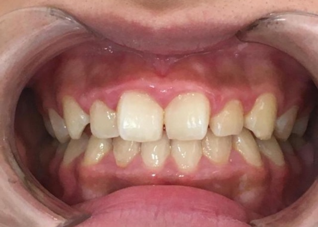 インビザラインGO治療　症例