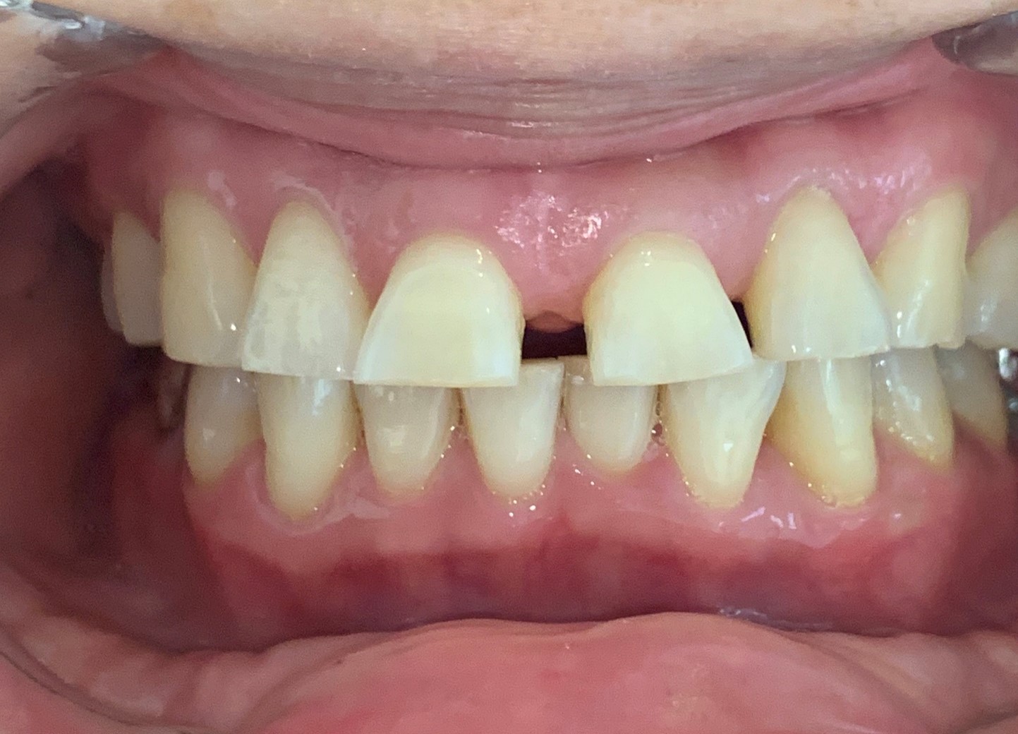 インビザライン治療　症例