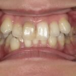 インビザライン治療　症例