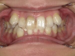 インビザライン治療　症例