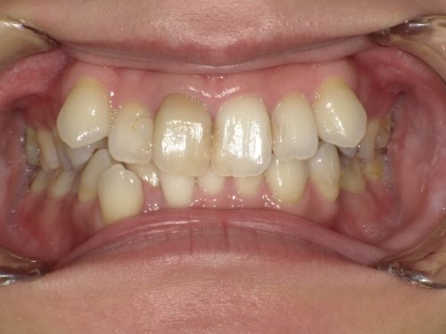 インビザライン治療 症例
