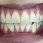 インビザライン治療　症例