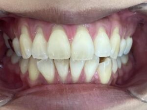 インビザライン治療　症例