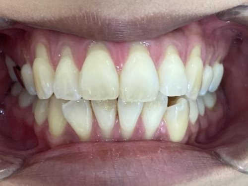 インビザライン治療　症例