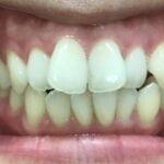 インビザライン治療　症例
