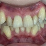 インビザライン治療　症例