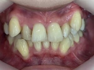 インビザライン治療　症例