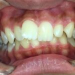 インビザライン治療　症例