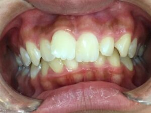 インビザライン治療　症例
