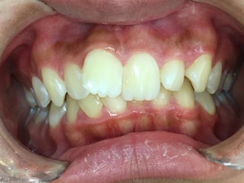 インビザライン治療　症例