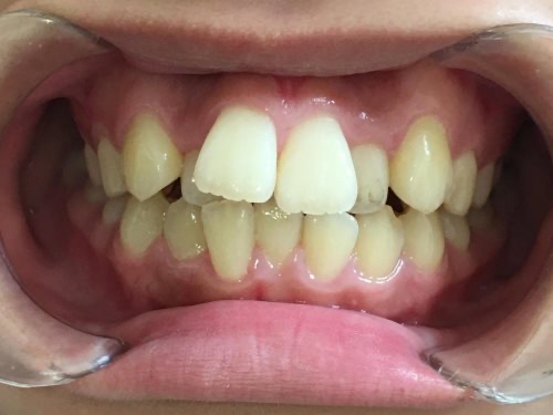 インビザライン治療　症例
