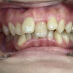 インビザライン治療　症例