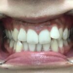 インビザライン治療　症例